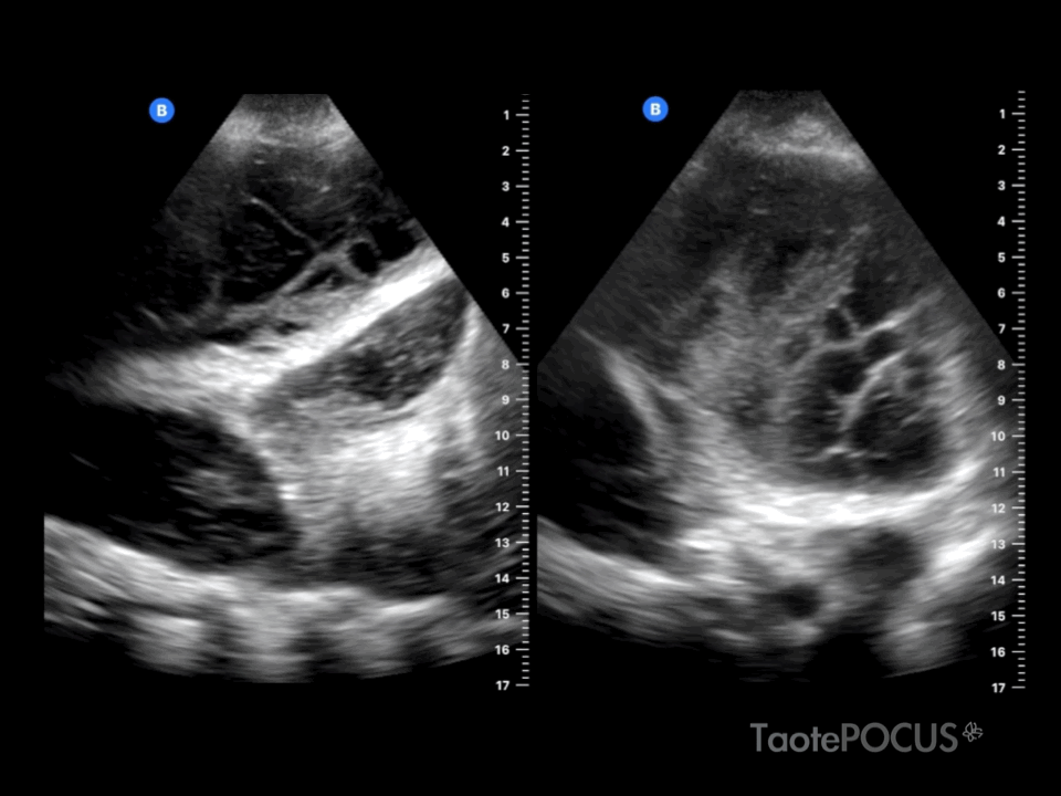Derrame pleural con tabiques en su interior, característico del empiema. Recurso 6 de 6.