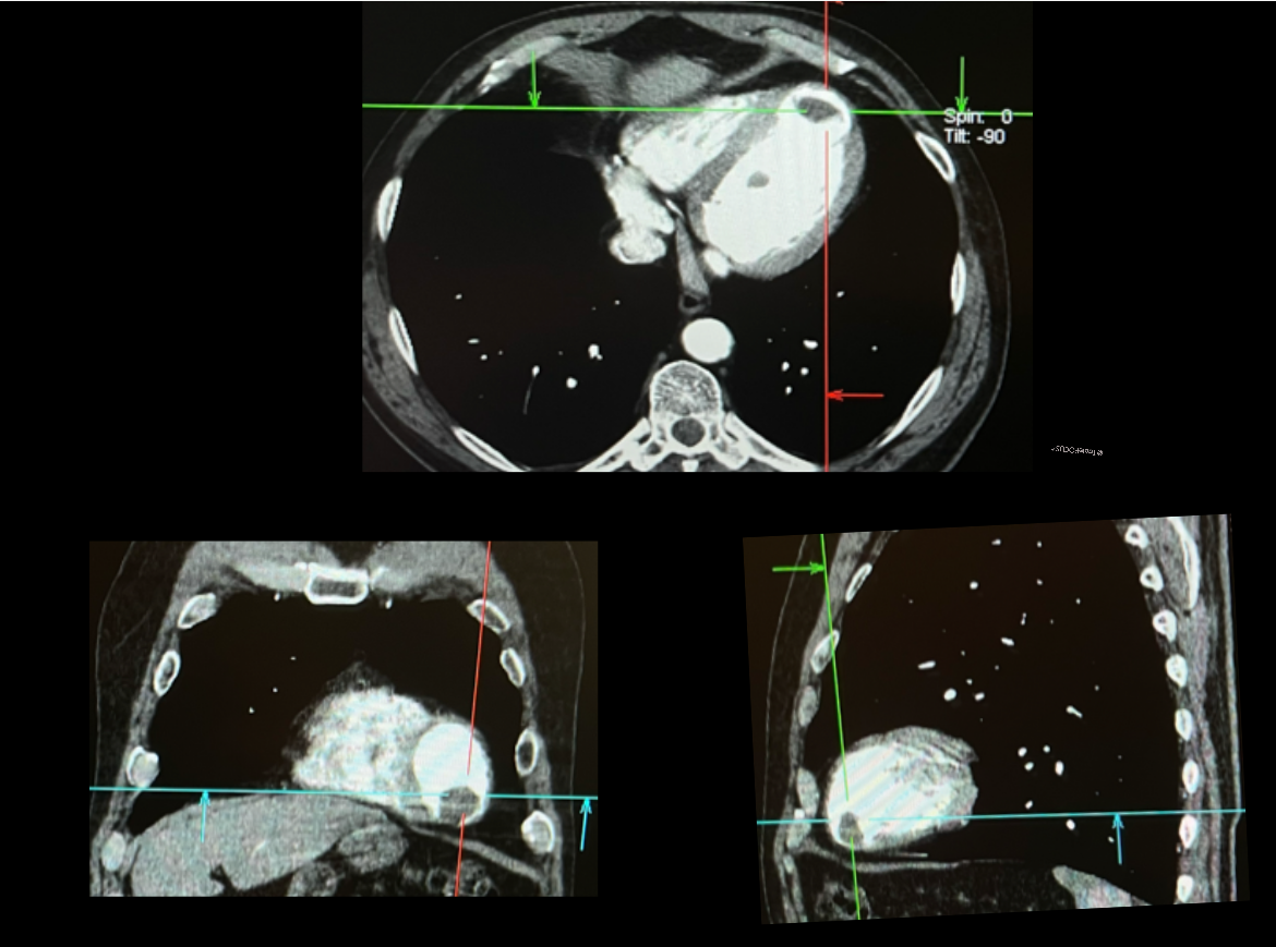 Alteración de la motilidad anterior y apical por infarto extenso del territorio de la arteria descendente anterior. Recurso 4 de 4.