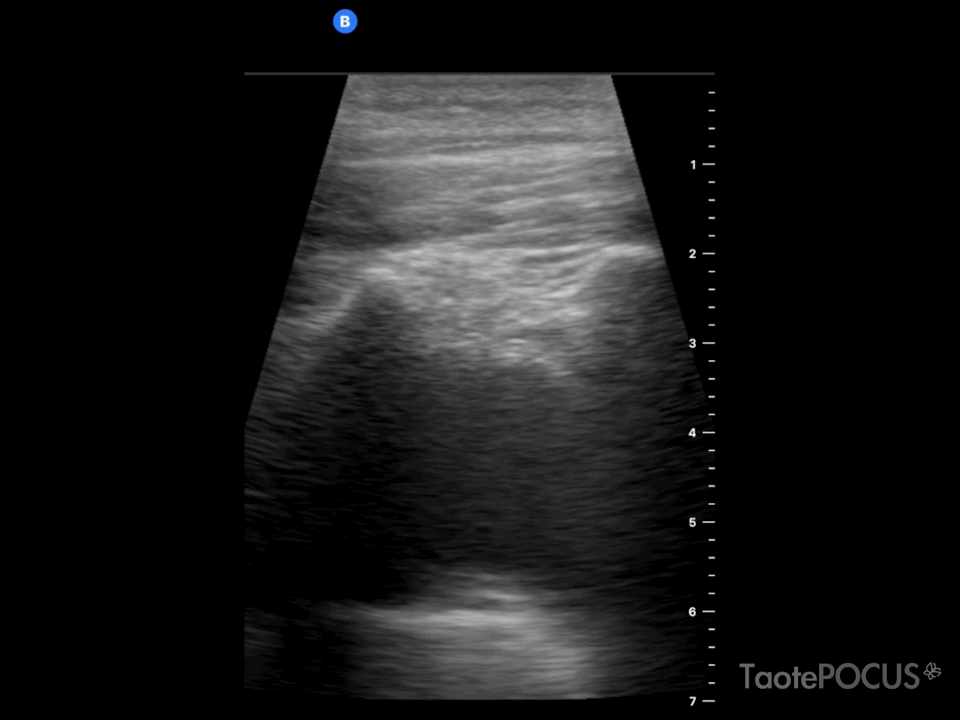 Aorta torácica dilatada que puede confundirse con un derrame pleural y llevar a puncionar por error; se muestra en 2D y con Doppler color. Recurso 2 de 2.