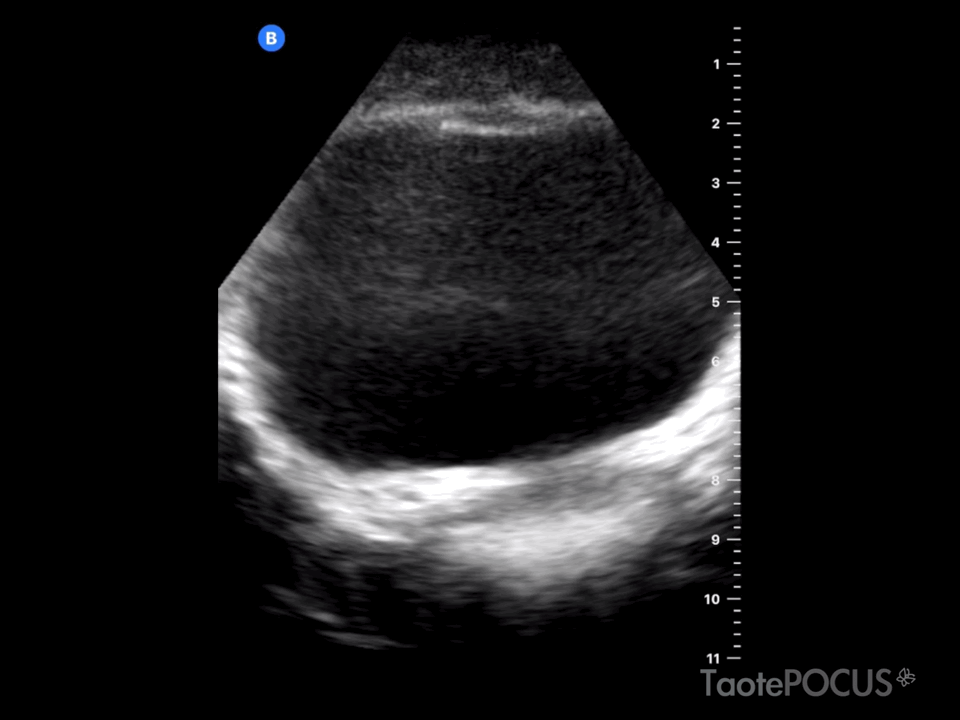 Jet ureteral en la vejiga.