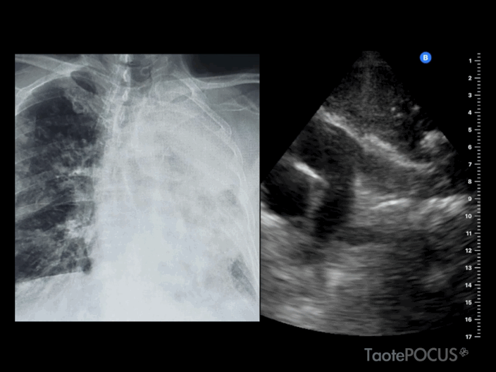 Masa pulmonar visible en ecografía, con la radiografía de tórax como correlato. Recurso 2 de 3.