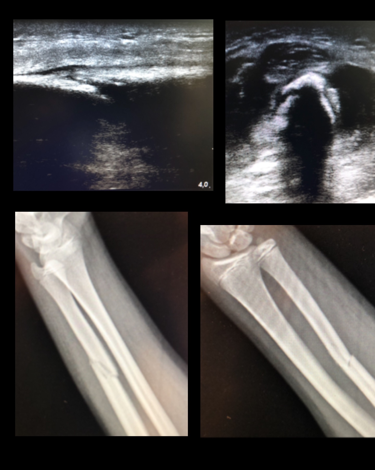 Fractura en el brazo, con la correlación entre ecografía y radiografía.