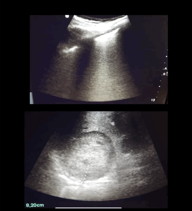 Líneas B difusas por edema pulmonar agudo, junto a una masa en hipocondrio derecho correspondiente a un feocromocitoma.