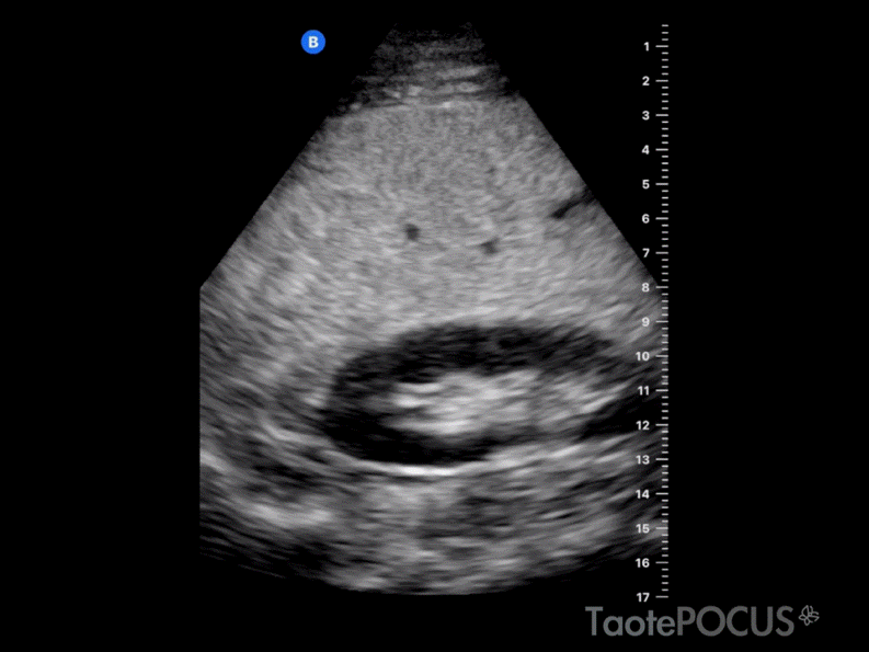 Hígado con esteatosis severa.