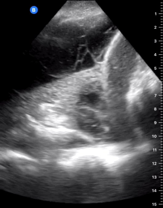 Derrame pleural con tabiques en su interior, característico del empiema. Recurso 4 de 6.