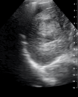 Hepatocarcinoma en el lóbulo hepático derecho, con ascitis y estudio Doppler color. Recurso 2 de 2.