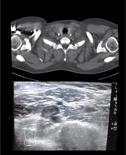 AngioTAC positivo para tromboembolismo pulmonar con signos de sobrecarga derecha, junto a la ecografía que muestra trombosis venosa poplítea.