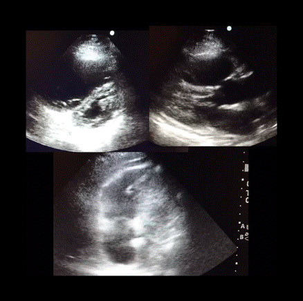 Signos de sobrecarga derecha cardíaca en un paciente con tromboembolismo pulmonar que consultó por síncope, hipotensión y taquicardia, con anemia severa de origen ginecológico.
