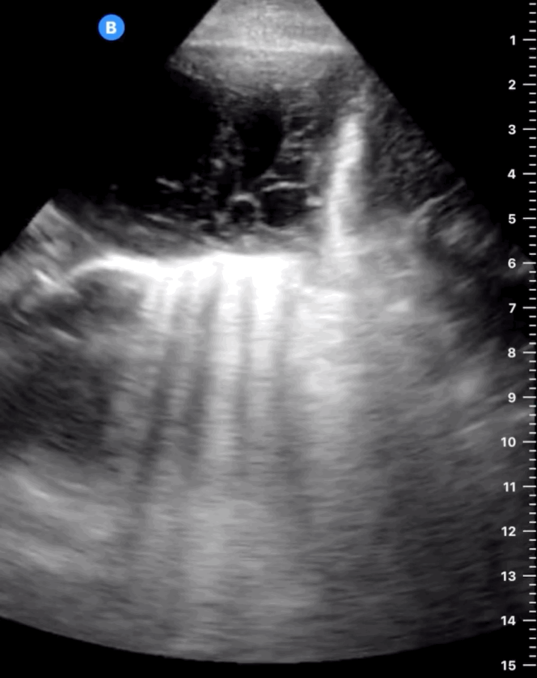 Derrame pleural con tabiques en su interior, característico del empiema. Recurso 5 de 6.