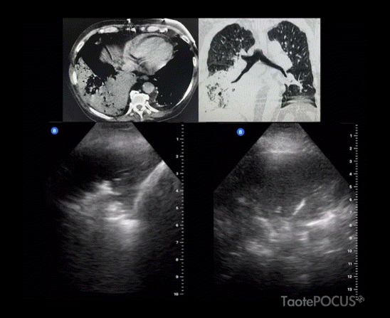Consolidación en el lóbulo inferior derecho, con correlación tomográfica.