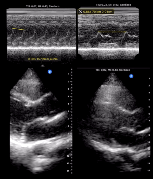 Taquicardia paroxística supraventricular y el mismo corazón ya en ritmo sinusal tras la adenosina.