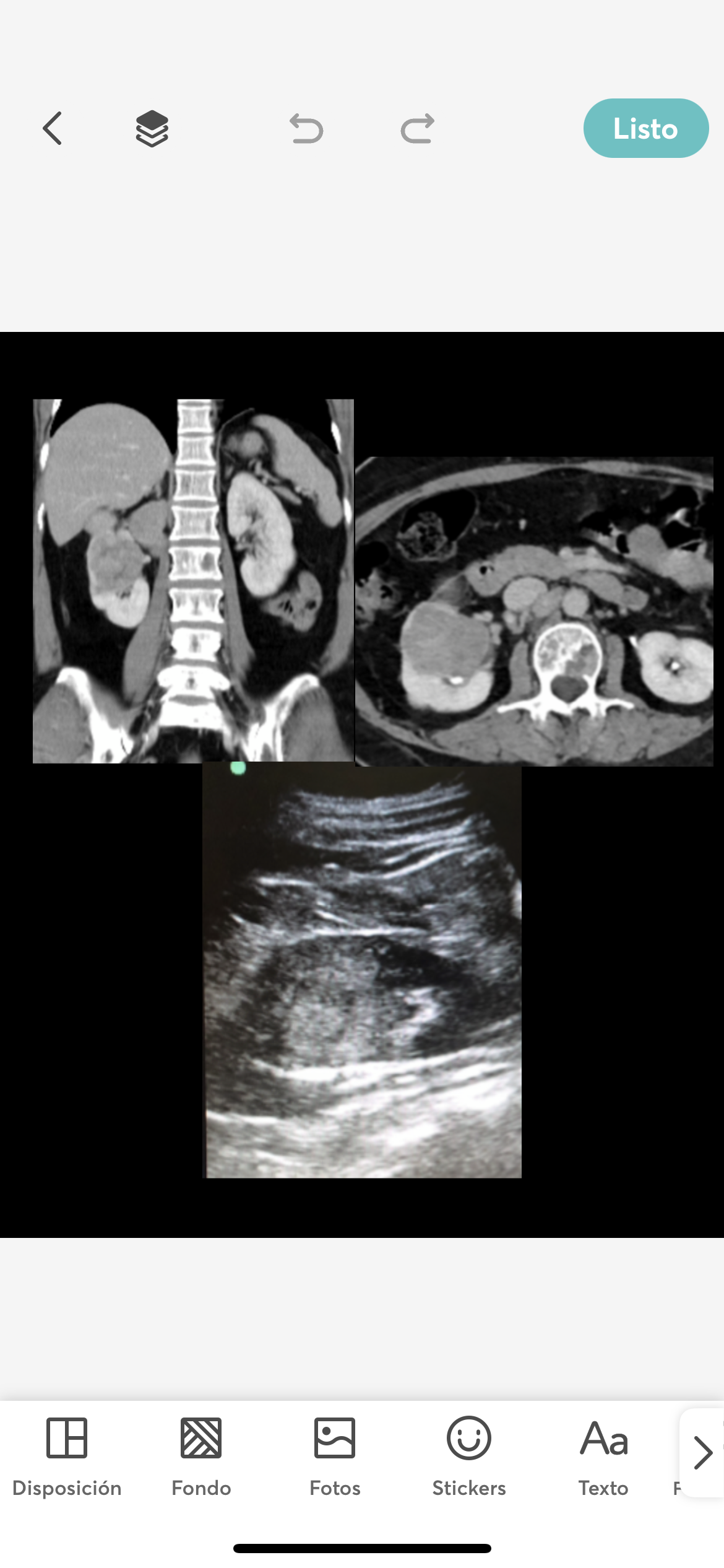 Masa renal secundaria a cáncer.
