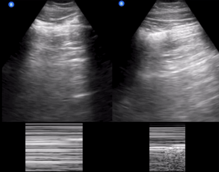 Dos columnas comparadas: en la primera no hay deslizamiento pleural, con su modo M debajo; en la segunda aparece el punto pulmonar con el modo M correspondiente.