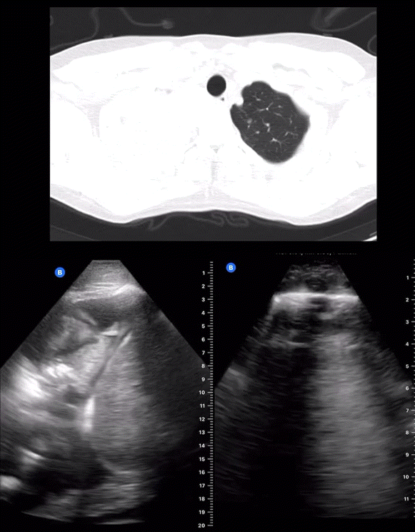 Derrame pleural complejo por hemotórax y lesiones metastásicas en un cáncer pulmonar, con el video tomográfico.