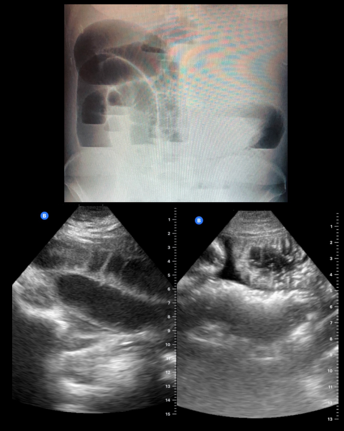 Signos ecográficos de obstrucción intestinal. Recurso 4 de 4.